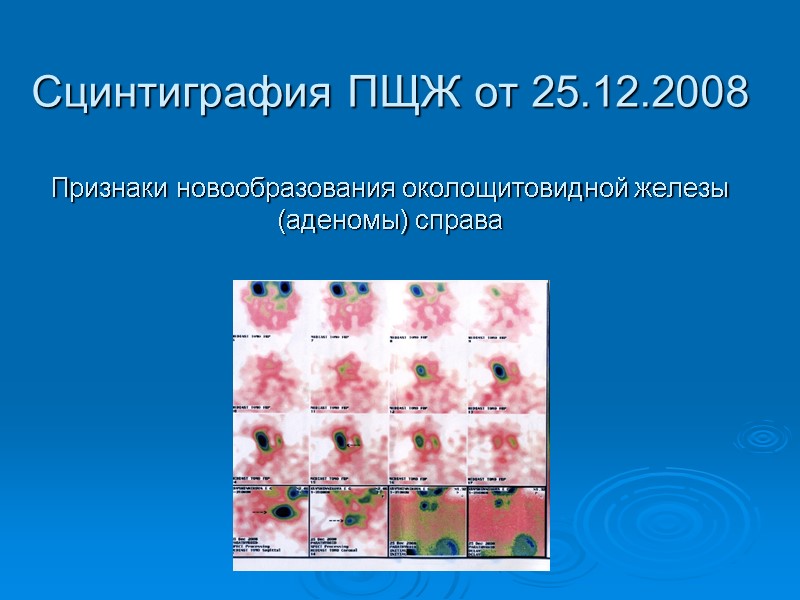 Сцинтиграфия ПЩЖ от 25.12.2008  Признаки новообразования околощитовидной железы (аденомы) справа